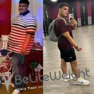 Weight Loss Surgery Before And After